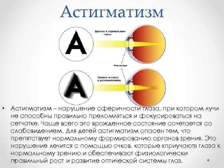 Астигматизм • Астигматизм – нарушение сферичности глаза, при котором лучи не способны правильно преломляться