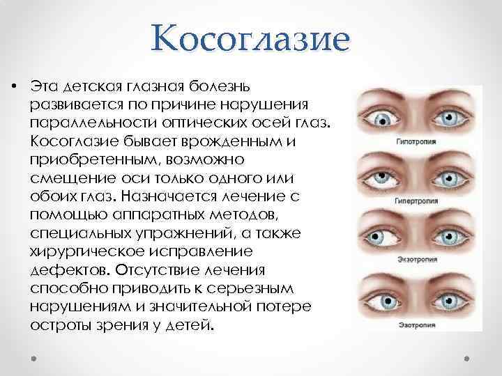 Косоглазие • Эта детская глазная болезнь развивается по причине нарушения параллельности оптических осей глаз.