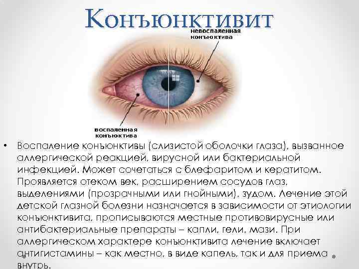 Конъюнктивит • Воспаление конъюнктивы (слизистой оболочки глаза), вызванное аллергической реакцией, вирусной или бактериальной инфекцией.
