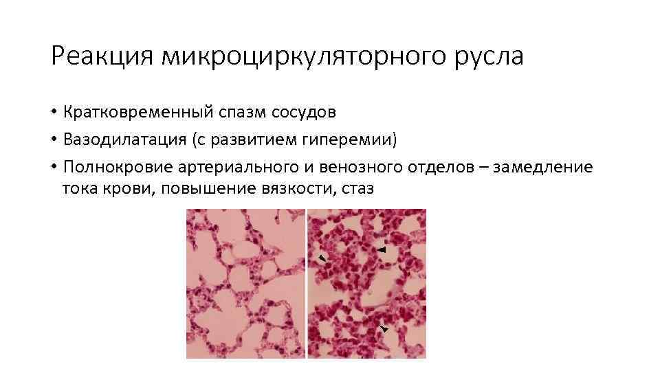 Реакция микроциркуляторного русла • Кратковременный спазм сосудов • Вазодилатация (с развитием гиперемии) • Полнокровие