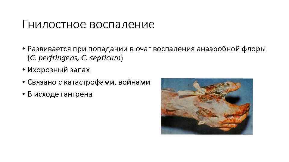 Гнилостное воспаление • Развивается при попадании в очаг воспаления анаэробной флоры (C. perfringens, C.