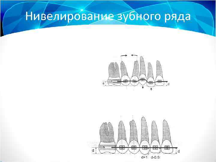 Нивелирование зубного ряда 
