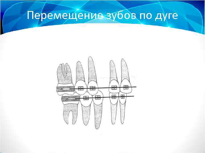 Перемещение зубов по дуге 