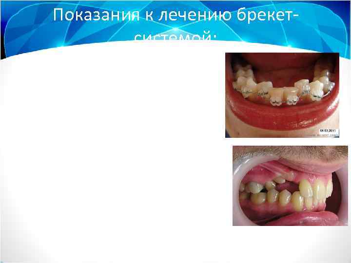 Показания к лечению брекетсистемой: 