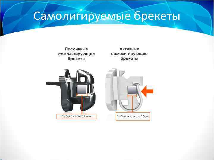 Самолигируемые брекеты 