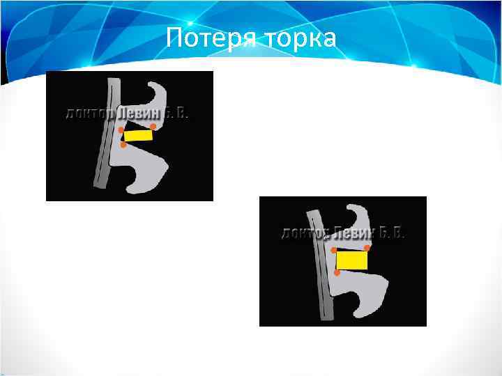 Потеря торка 