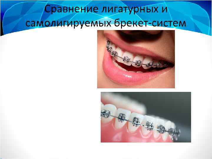 Сравнение лигатурных и самолигируемых брекет-систем 