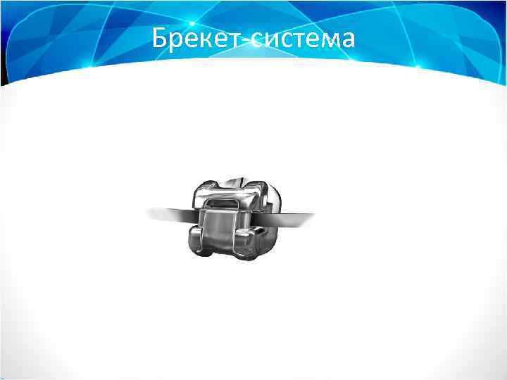 Брекет-система 