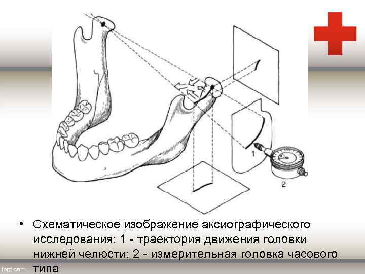  • Схематическое изображение аксиографического исследования: 1 траектория движения головки нижней челюсти; 2 измерительная