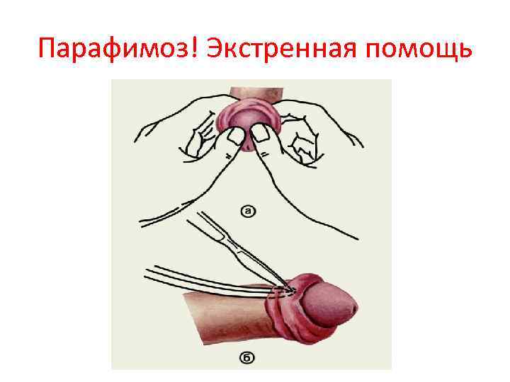 Парафимоз! Экстренная помощь 