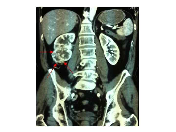Опухоль почки мрт. Опухоль почки мрт. Феохромоцитома надпочечника кт. Опухоль почки мрт. Опухоль почки мрт снимок.