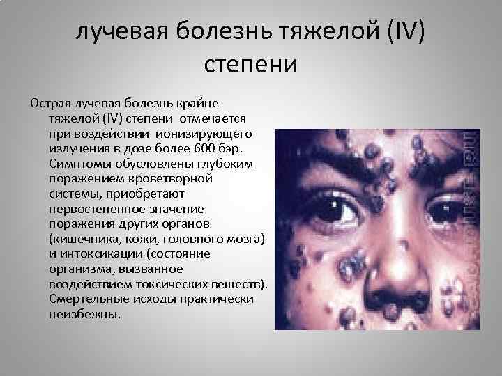 лучевая болезнь тяжелой (IV) степени Острая лучевая болезнь крайне тяжелой (IV) степени отмечается при