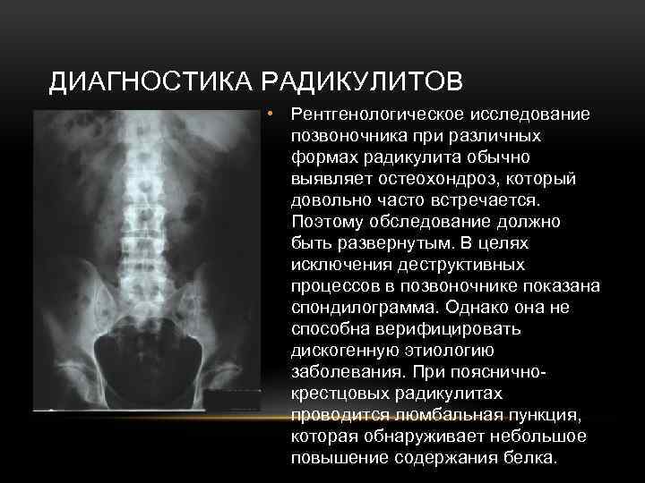 ДИАГНОСТИКА РАДИКУЛИТОВ • Рентгенологическое исследование позвоночника при различных формах радикулита обычно выявляет остеохондроз, который