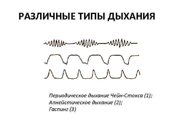 2 виды дыхания. Типы периодического дыхания схема. Периодические типы дыхания. Механизм дыхания Чейна Стокса. Дыхание типа гаспинг.