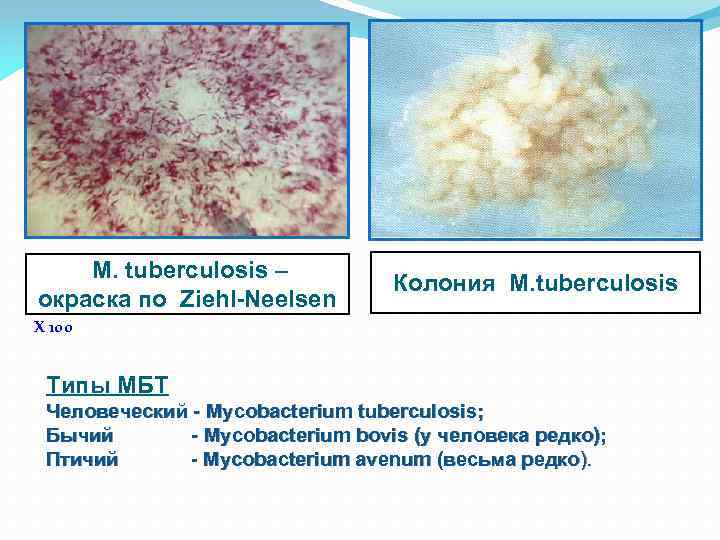 M. tuberculosis – окраска по Ziehl-Neelsen Колония M. tuberculosis Х 100 Типы МБТ Человеческий