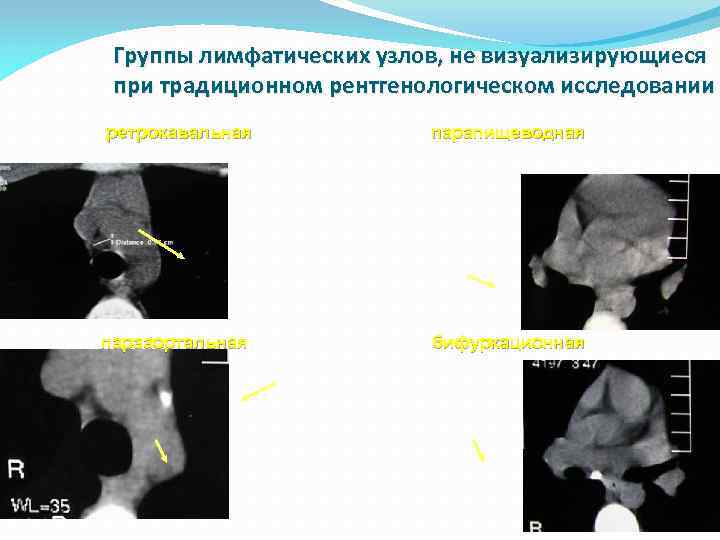 Группы лимфатических узлов, не визуализирующиеся при традиционном рентгенологическом исследовании ретрокавальная парапищеводная парааортальная бифуркационная 
