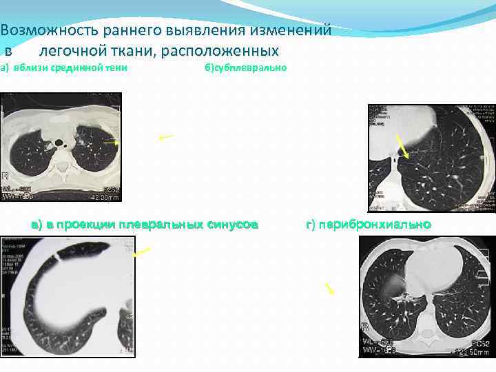 Возможность раннего выявления изменений в легочной ткани, расположенных а) вблизи срединной тени б)субплеврально в)