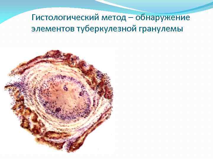 Гистологический метод – обнаружение элементов туберкулезной гранулемы 