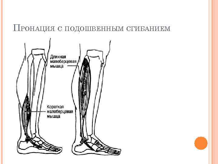 ПРОНАЦИЯ С ПОДОШВЕННЫМ СГИБАНИЕМ 