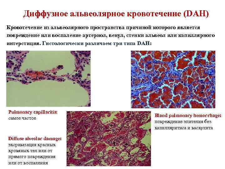 Диффузное альвеолярное кровотечение (DAH) Кровотечение из альвеолярного пространства причиной которого является повреждение или воспаление