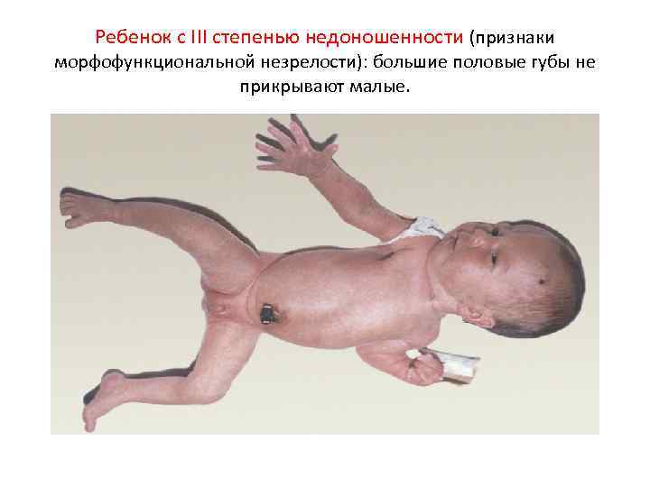 Ребенок с III степенью недоношенности (признаки морфофункциональной незрелости): большие половые губы не прикрывают малые.