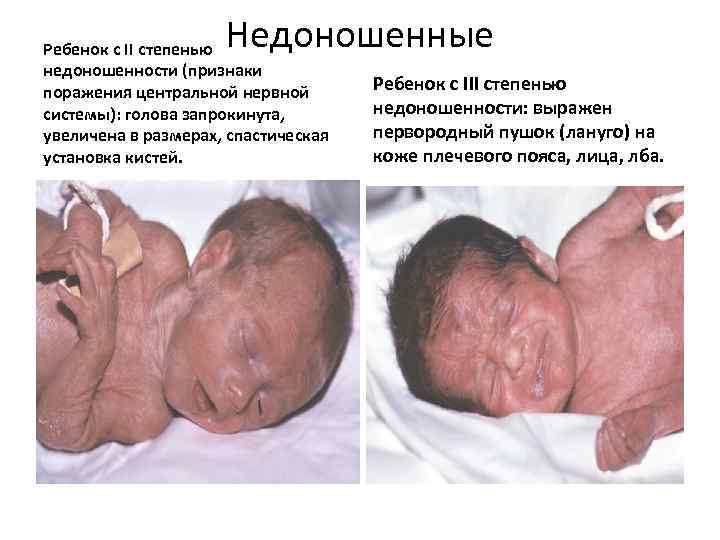 Недоношенные Ребенок с II степенью недоношенности (признаки поражения центральной нервной системы): голова запрокинута, увеличена