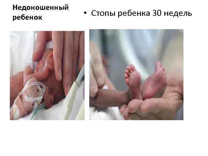 Недоношенный ребенок • Стопы ребенка 30 недель 