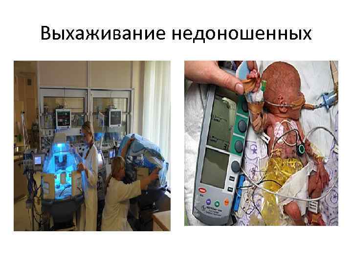 Выхаживание недоношенных 
