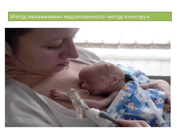 Метод выхаживания недоношенного- метод «кенгуру» 