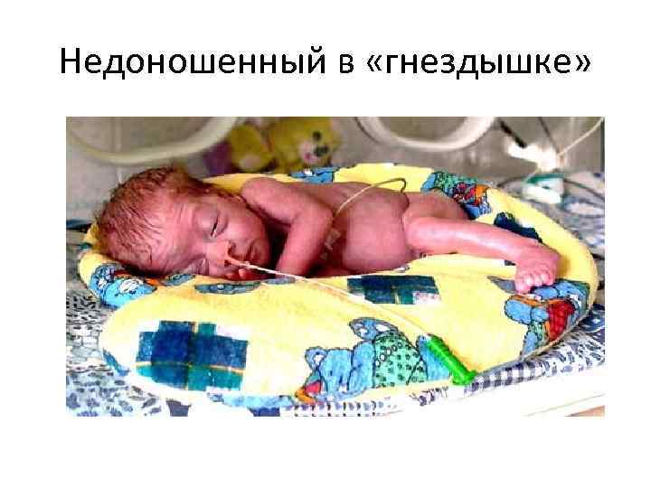 Недоношенный в «гнездышке» 