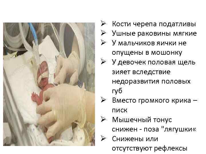 Ø Кости черепа податливы Ø Ушные раковины мягкие Ø У мальчиков яички не опущены