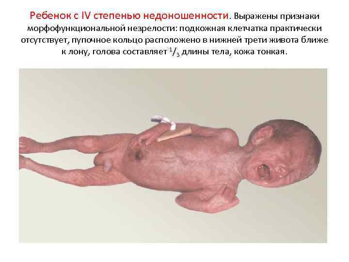 Ребенок с IV степенью недоношенности. Выражены признаки морфофункциональной незрелости: подкожная клетчатка практически отсутствует, пупочное