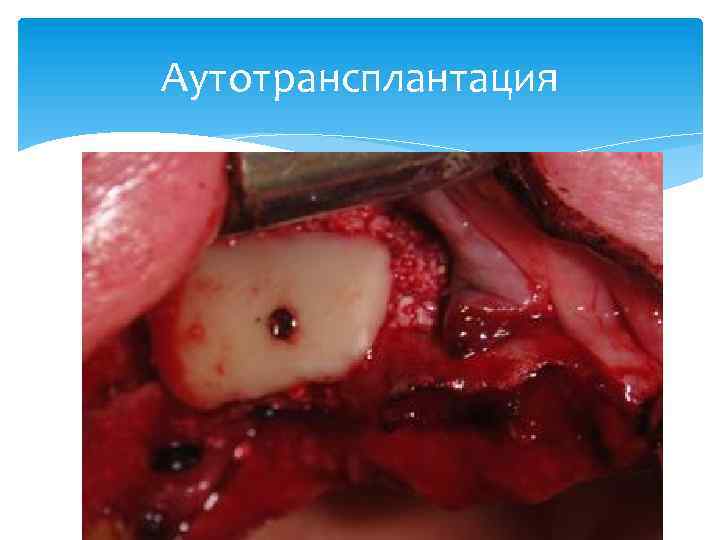 Аутотрансплантация 