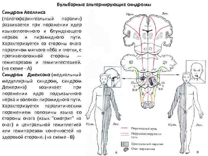 Альтернирующие синдромы презентация