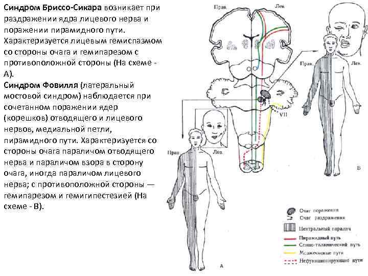 Альтернирующие синдромы презентация