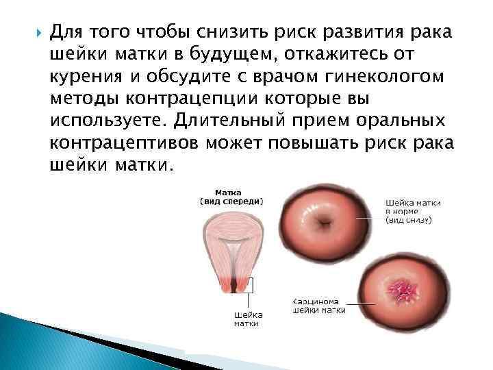  Для того чтобы снизить риск развития рака шейки матки в будущем, откажитесь от