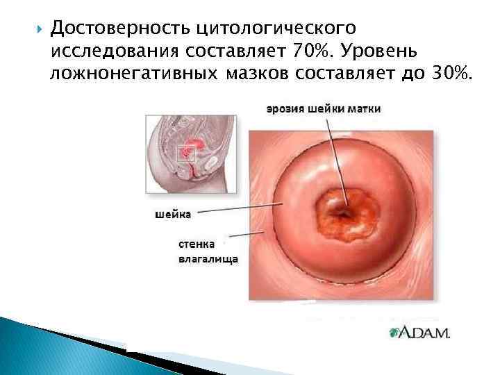  Достоверность цитологического исследования составляет 70%. Уровень ложнонегативных мазков составляет до 30%. 