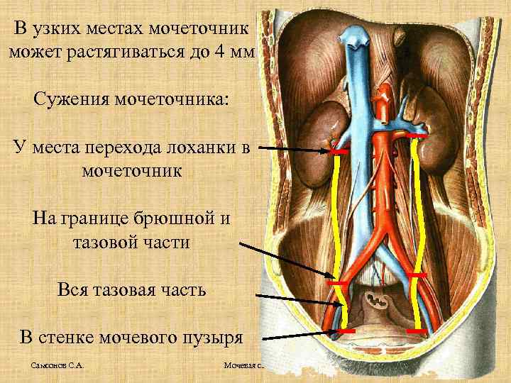 В узких местах мочеточник может растягиваться до 4 мм Сужения мочеточника: У места перехода