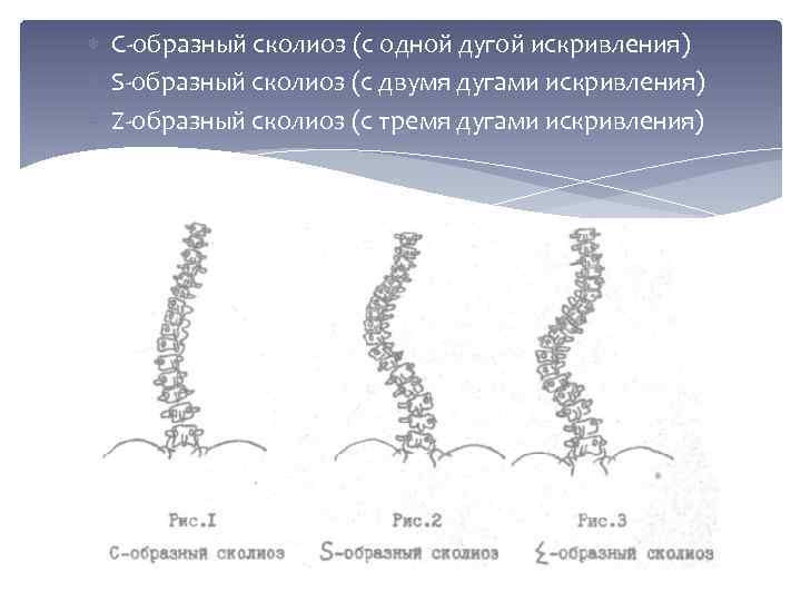 Сколиоз степени