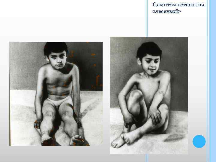 Симптом вставания «лесенкой» 