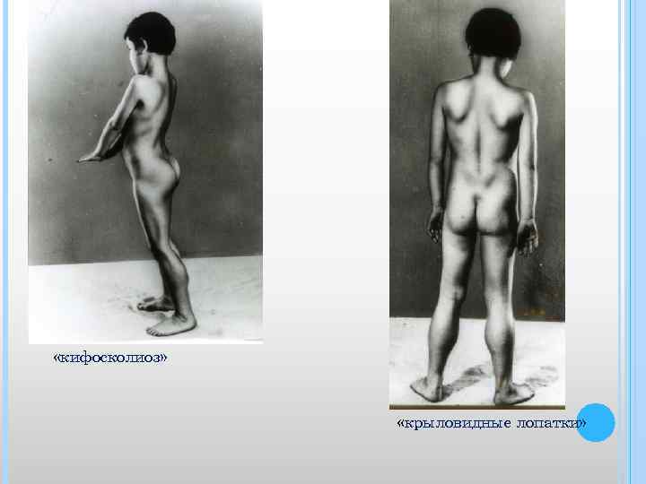  «кифосколиоз» «крыловидные лопатки» 