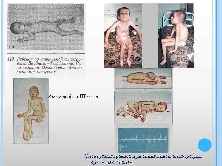 Амиотрофия III типа Электромиограмма при спинальной амиотрофии — «ритм частокола» 