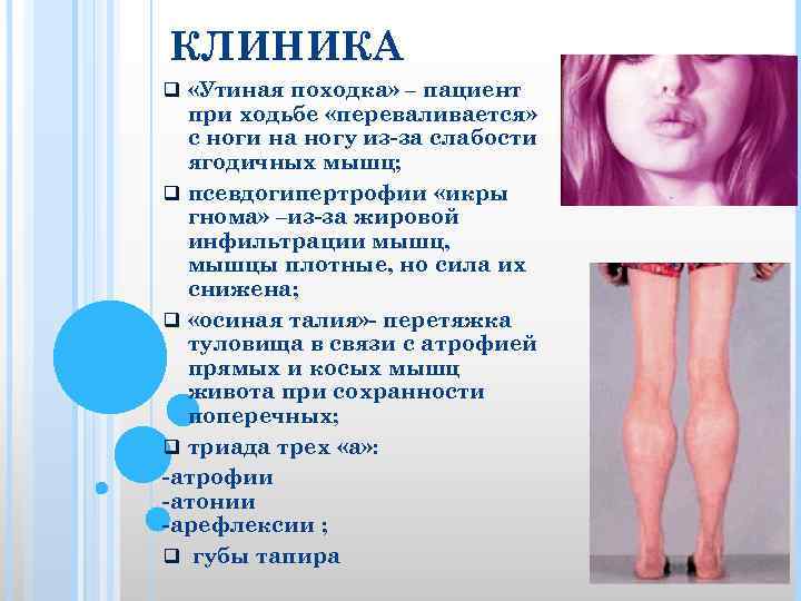 КЛИНИКА q «Утиная походка» – пациент при ходьбе «переваливается» с ноги на ногу из-за