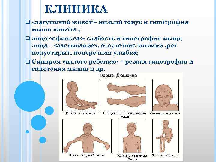 КЛИНИКА q «лягушачий живот» - низкий тонус и гипотрофия мышц живота ; q лицо