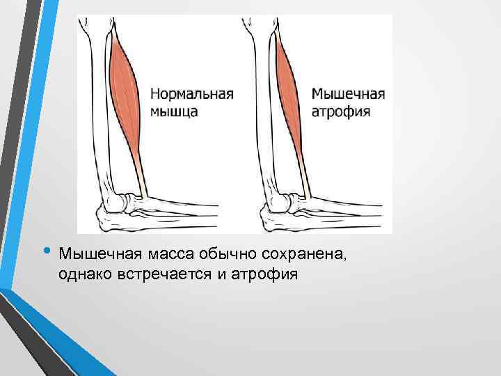  • Мышечная масса обычно сохранена, однако встречается и атрофия 