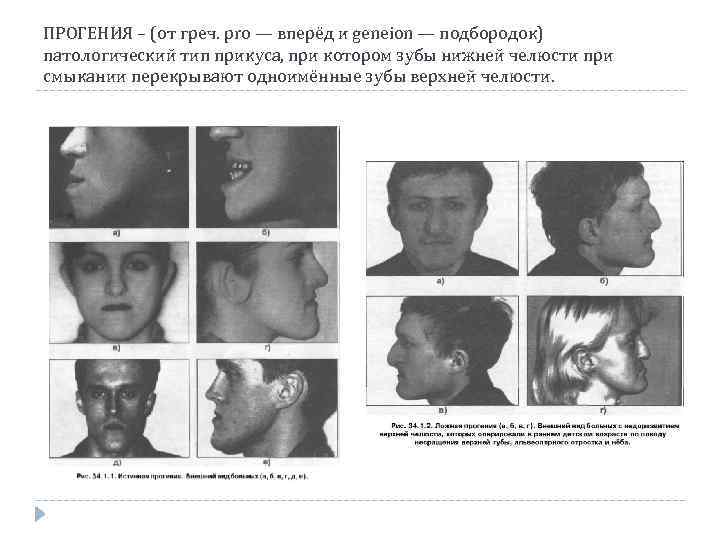ПРОГЕНИЯ – (от греч. pro — вперёд и geneion — подбородок) патологический тип прикуса,