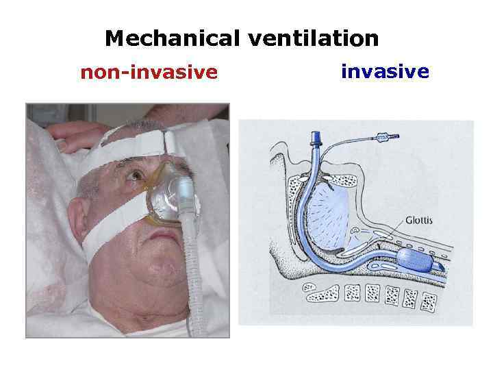 Mechanical ventilation non-invasive 