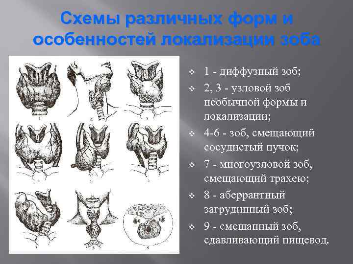 Схемы различных форм и особенностей локализации зоба v v v 1 - диффузный зоб;