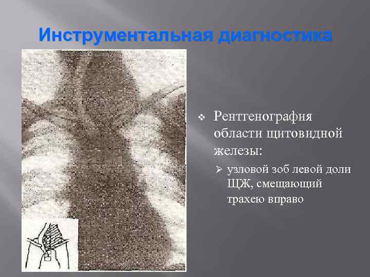 Инструментальная диагностика v Рентгенография области щитовидной железы: Ø узловой зоб левой доли ЩЖ, смещающий
