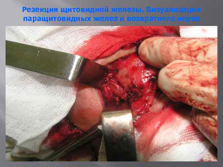 Резекция щитовидной железы. Визуализация паращитовидных желез и возвратного нерва 